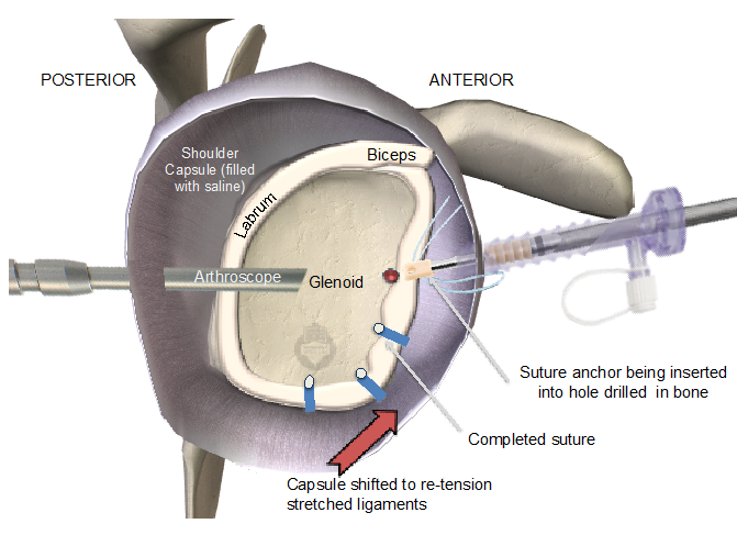 Arthroscopic Shoulder Stabilisation Bankart or Labral repair